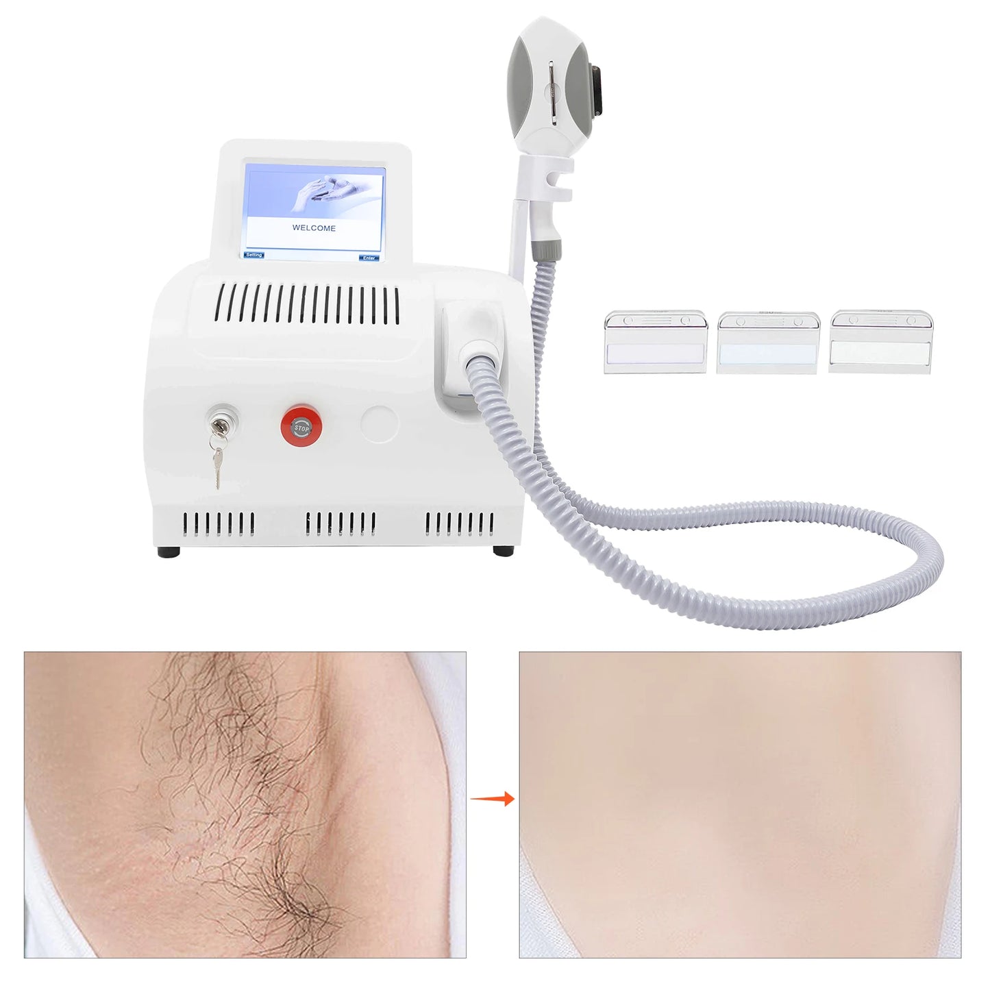 Laser Hair Removal RF Skin Rejuvenation