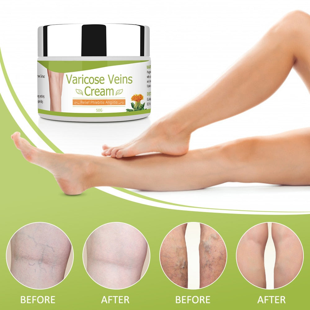 Varicose Veins Cream Natural Treatment Cream - peterkaczconnect