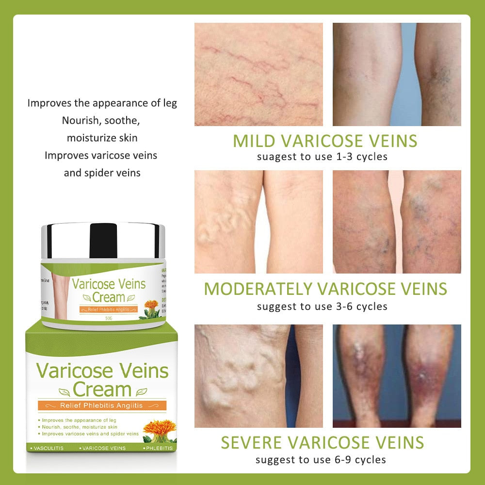 Varicose Veins Cream Natural Treatment Cream - peterkaczconnect