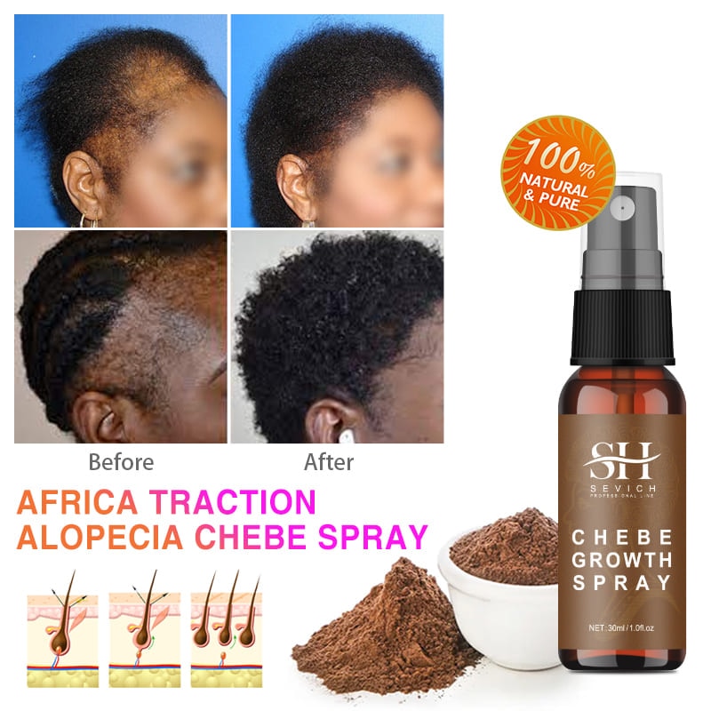 Alopecia Treatment Oil Hair Growth Spray Hair Loss Treatment - peterkaczconnect