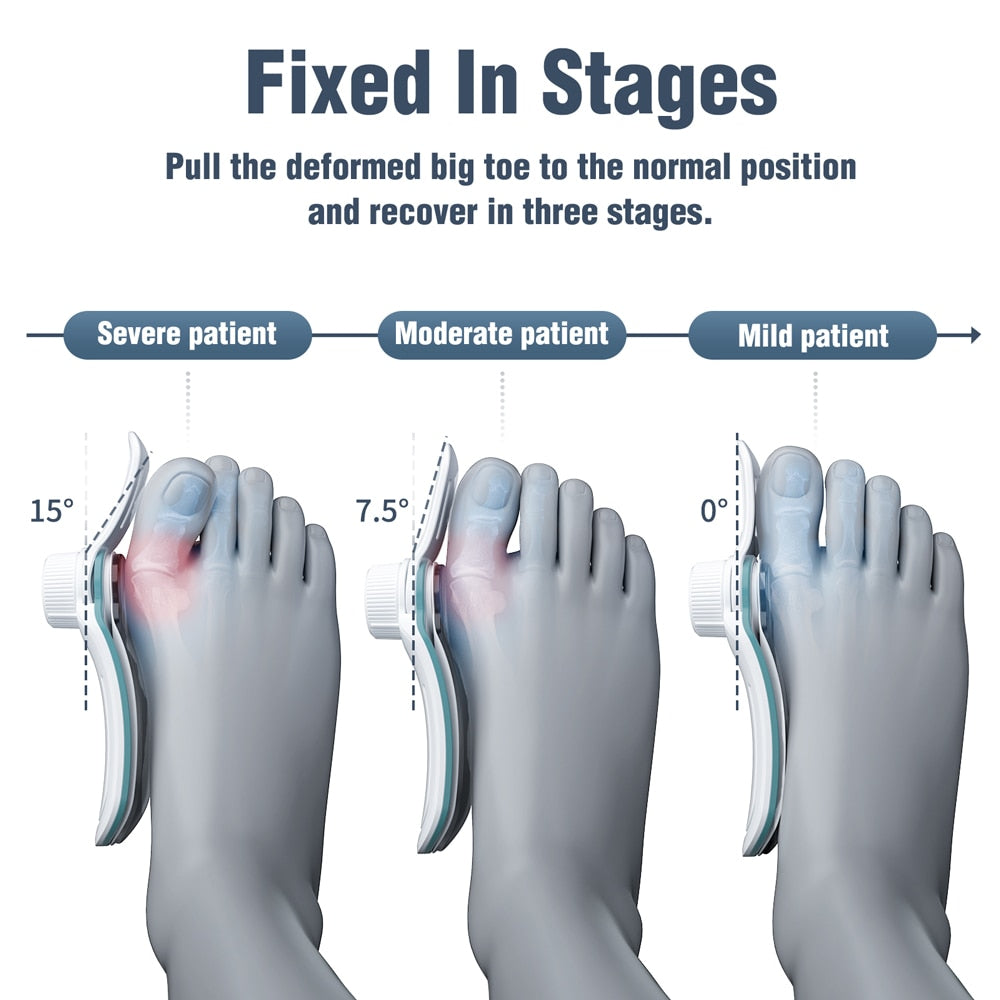 Bunion Splint Big Toe Straightener Corrector - peterkaczconnect