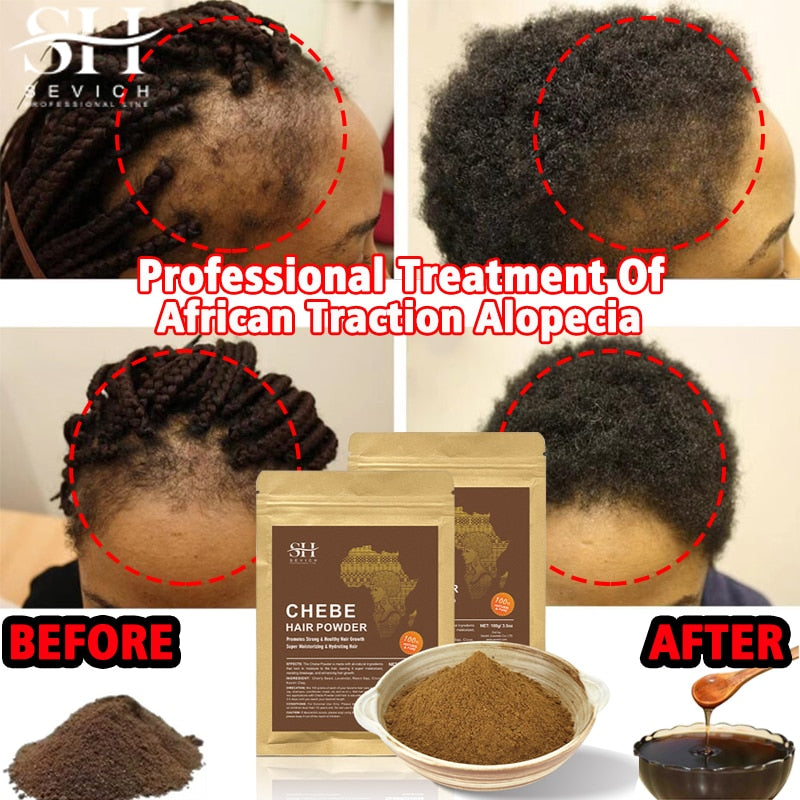 Alopecia Treatment Oil Hair Growth Spray Hair Loss Treatment - peterkaczconnect